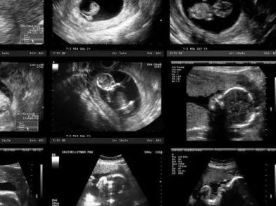 哈医大一院巧囊试管怎么样？哪些方面要注意？