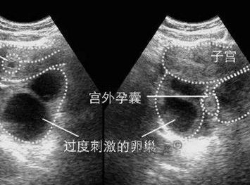 福州试管婴儿产检要去哪里？产检要注意什么？